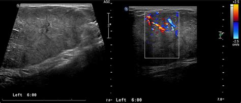 Ultrasound Image Of 100 X 80 X 43 Cm Left Breast Mass Note The