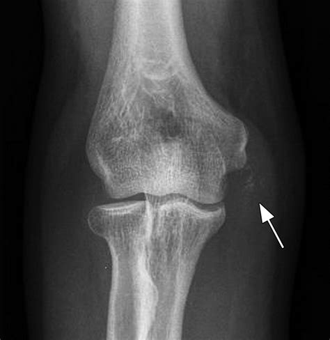 Elbow Radiography Anterior Posterior View Lateral Epicondyle My Xxx