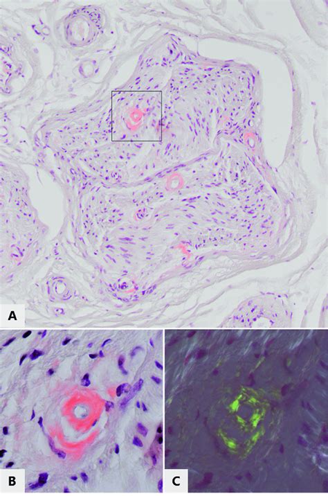 Amyloid Deposits Inaround Small Endoneurial Blood Vessels In The Left