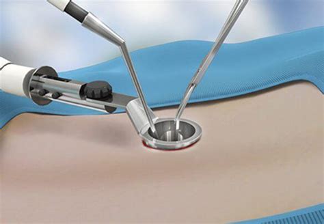 Small Incisions Big Results Minimally Invasive Spine Surgery