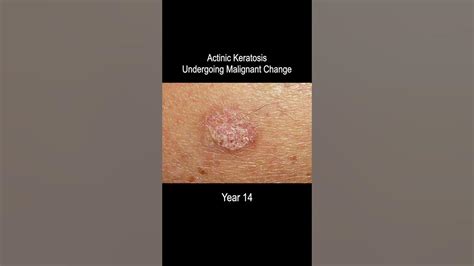 Skin Cancer Development Time Lapse Normal To Squamous Cell Carcinoma