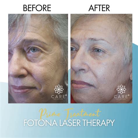 Laser Therapy Fotona Laser Treatment Sarasota