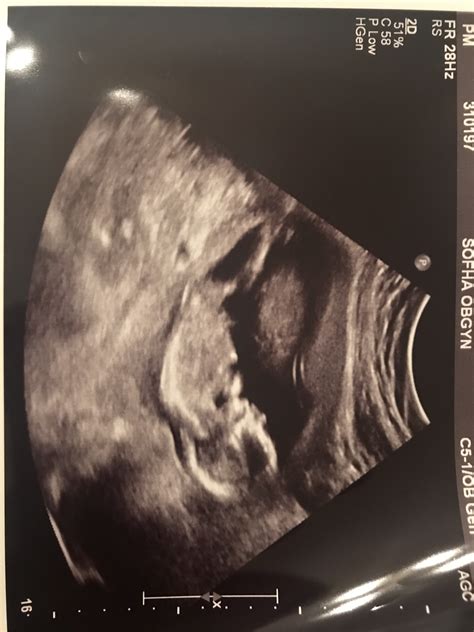 Ultrasound Gender Confusion Please Help