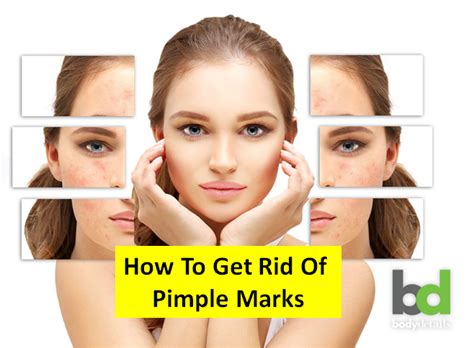 How To Get Rid Of Pimple Marks Top 5 Diy
