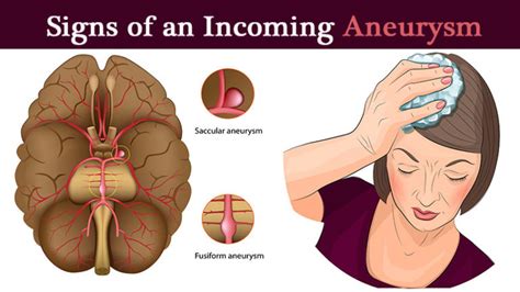 5 Signs It May Be A Brain Aneurysm Womenworking