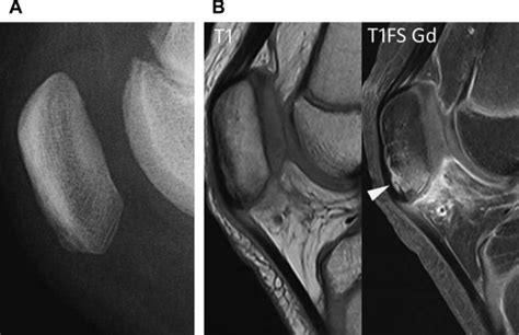 Knee Bone Anatomy Tibial Tuberosity