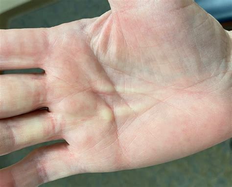 Orthodx Firm Nodule On Palm Of Hand