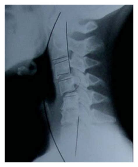 Simple Radiograph Demonstrating C4 C5 Subluxation As Well As C5 C6