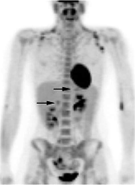 Characterization Of The Normal Adrenal Gland With 18f Fdg Petct