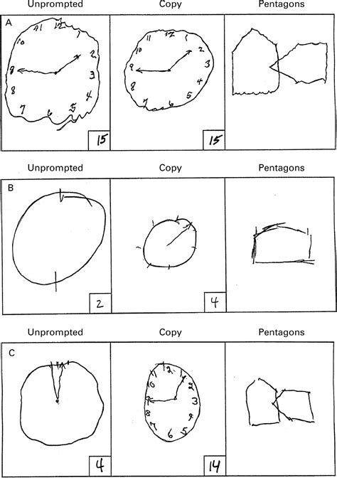 One point each is given for the numbers 1, 2, 4, 5, 7, 8, 10, and 11 if at least half the area of the number is in the proper octant of the circle relative to the number 12. CLOX: an executive clock drawing task | Journal of ...