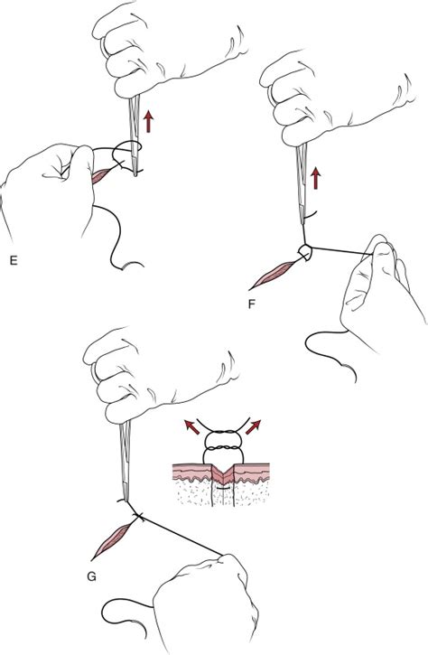 Basic Laceration Repair Principles And Techniques Anesthesia Key