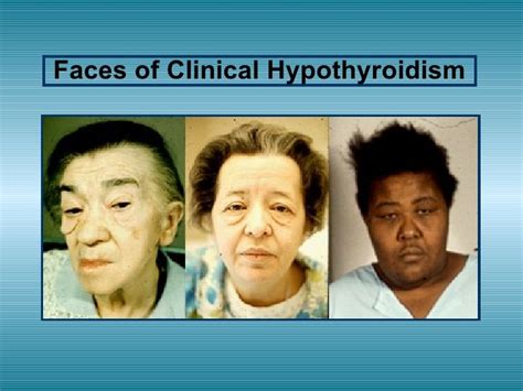 Hypothyroidism Symptoms Face To View Further For This Article