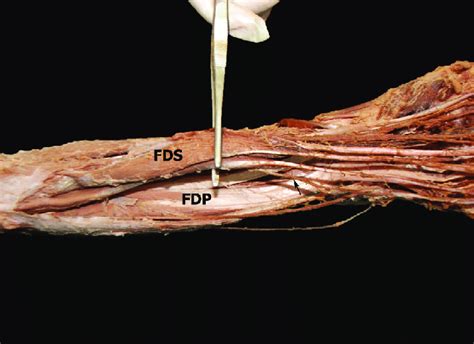 Proach is based partly on surgeon preference and. Anterior aspect of the left forearm. FDS: fl exor digitorum superFDS:... | Download Scientific ...