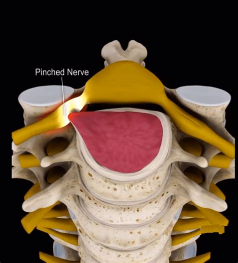 If You Have A Pinched Nerve In Your Neck Read On