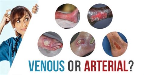 Venous Vs Arterial Ulcers Whats The Difference WCEI Blog WCEI Blog