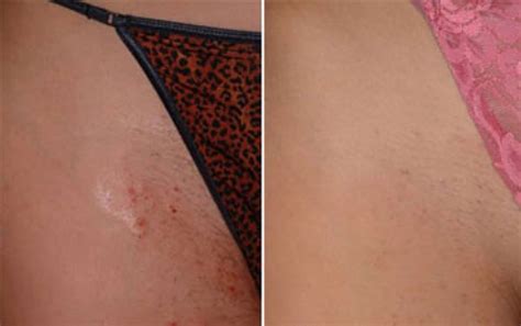 Lasers used for hair removal are specifically designed to absorb into melanin (brown pigment). Before & After Pictures - Dermalaser Med Spa