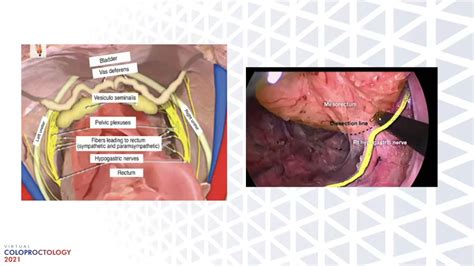 Low Anterior Resection Syndrome For Healthcare Professionals Youtube
