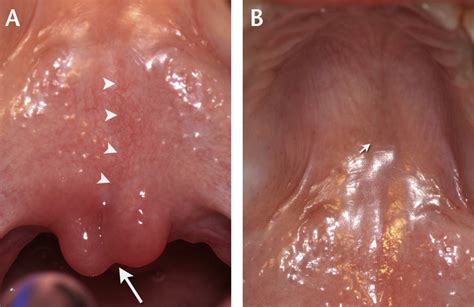 Submucous Cleft Palate With Bifid Uvula The Journal Of Pediatrics
