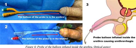 Figure 4 From Tips And Tricks For Difficult Urethral Catheterization