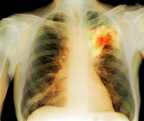 Lung Abscessx Ray Bild Kaufen 11590948 Science Photo Library