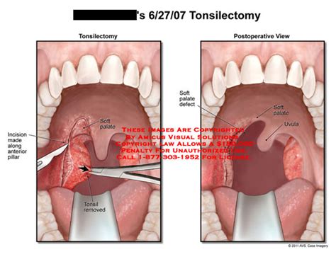 AMICUS Illustration Of Amicus Surgery Tonsils Tonsilectomy Incision