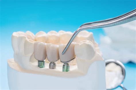 Qué son los puentes dentales y cómo funcionan Diente a diente