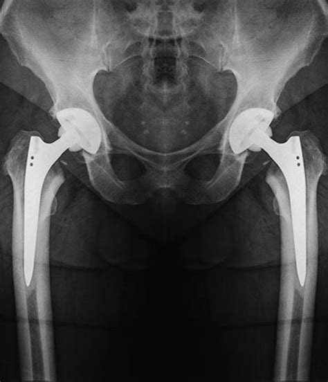 Bilateral Hip Replacement I Orthopaedics I St Vincents Private Hospitals