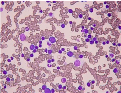 Malignant lymphoma is a common cancer in dogs. Canine bone marrow cytological examination. Erythroid ...