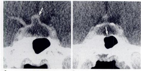 A Coned Lateral View Of Sella Turcica Mild Generalized Enlargement Of