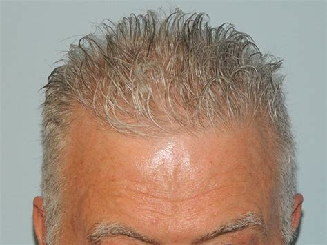 Patient 133066312 Hair Transplant Smartgraft Before And After Photos