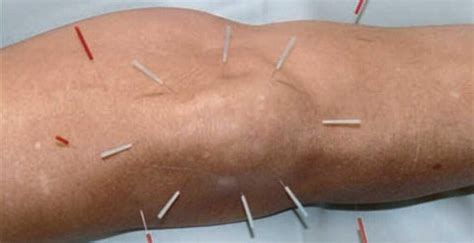 Acupuncture To Knee Osteoarthritis