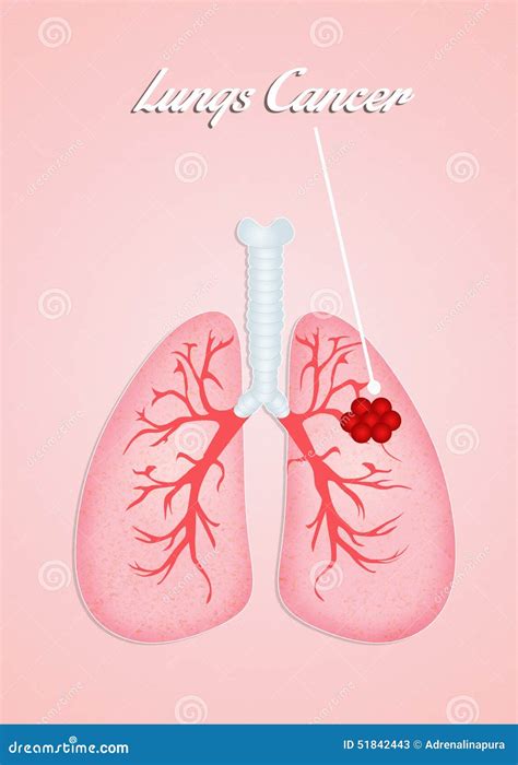 Lungs Cancer Stock Illustration Illustration Of Smoking 51842443