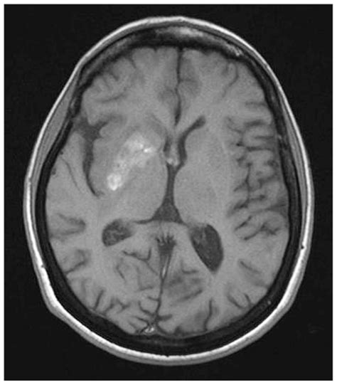 Cns Vasculitis In Lupus Spontaneous T1 Hyperintense Lesions In The