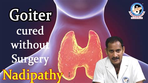 How To Shrink A Goiter Naturally