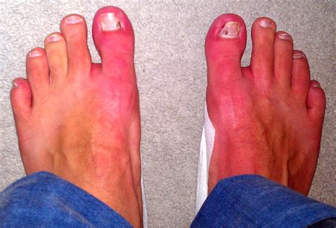 Erythromelalgia In Toes Info Not Crps Complex Regional Pain Syndrome