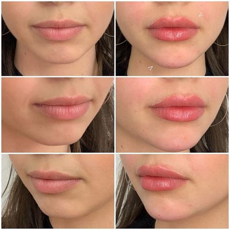 Ml Chin Filler To Improve Facial Proportions And Ml Of Lip Filler