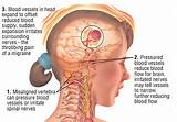 Pictures of Ice Pick Migraine Treatment