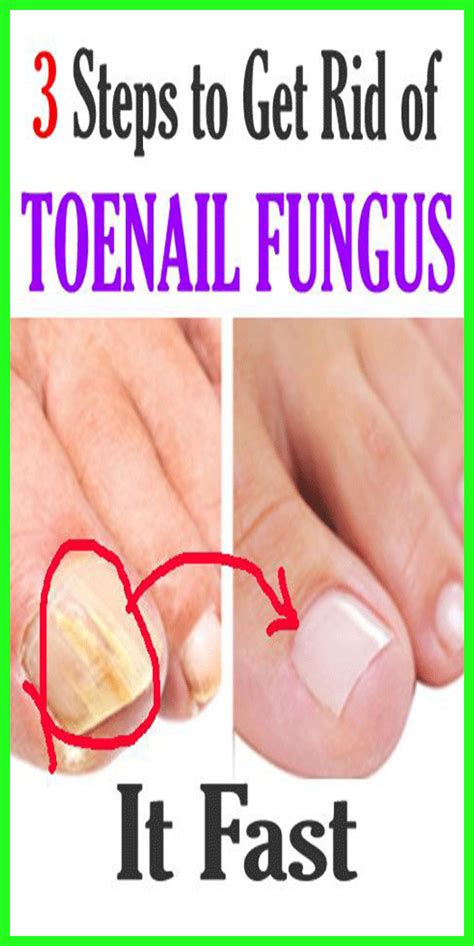 To clear up dark green toenails and fungus under acrylic nails 'nail fungus', i am very much sure you must be aware of this. Nail Fungus Can Be Dangerous Remove This By Using Recipe ...