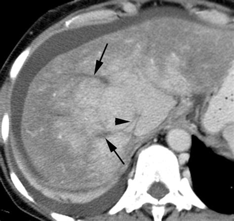 Ct Of Nonneoplastic Hepatic Vascular And Perfusion Disorders