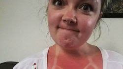 People Share Worst Sunburn Ever With One Woman Having Embarrassing Criss Cross Mirror Online