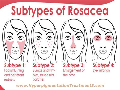 The Wardrobe Clinic Rosacea And The Types