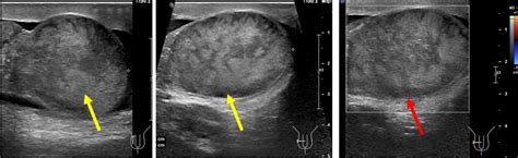 testicular torsion radiology cases