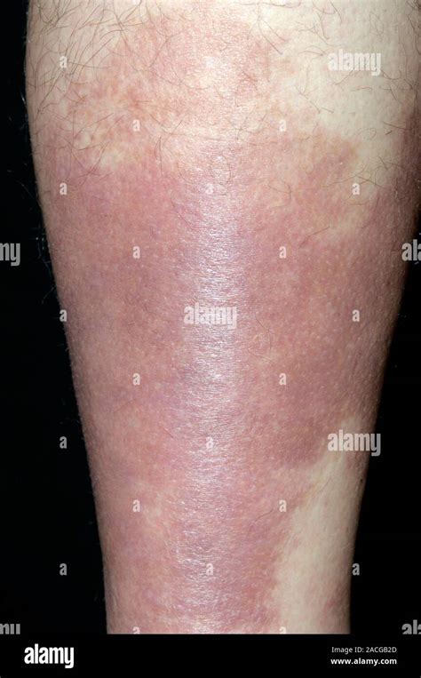 Pigmentation And Oedema Fluid Retention And Swelling After Cellulitis