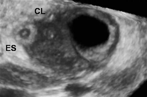Three‐dimensional Sonographic Diagnosis Of Ovarian Pregnancy Ghi