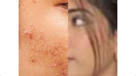 Acne Sy Clear Skin Tak Ka Safar Best Dermatologist In Islamabad 😊☺️