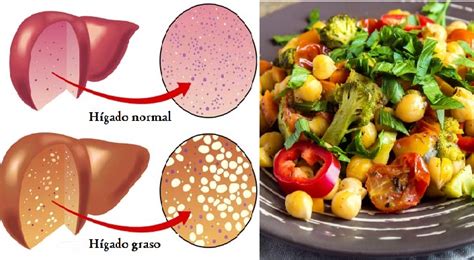 Dieta Para El Hígado Graso Y Qué Alimentos No Consumir