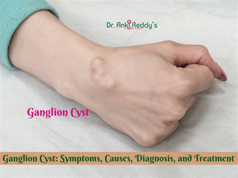 Ganglion Cyst Symptoms Causes Diagnosis And Treatment