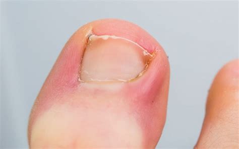 Update More Than 142 Infected Toe Nail Latest Ceg Edu Vn