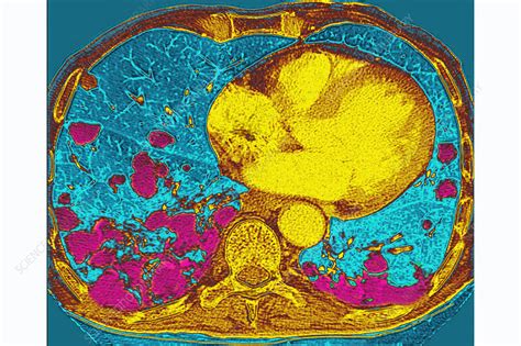 Lung Metastases Ct Scan Stock Image C0306796 Science Photo Library
