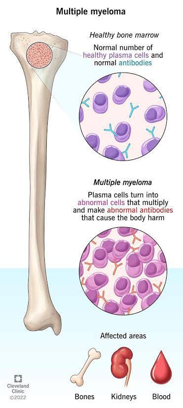 Symptoms Of Multiple Myeloma MEDizzy